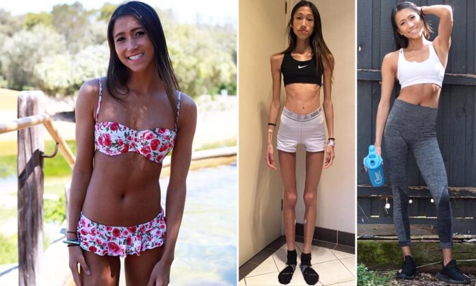 Kaip dabar atrodo mergina, kuri prieš dvejus metus svėrė vos 30 kg?