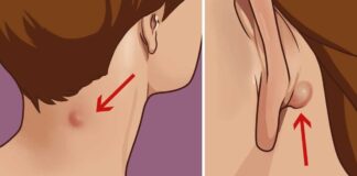 Kodėl atsiranda iškilimų už ausies ar ant kaklo ir kaip juos pašalinti?