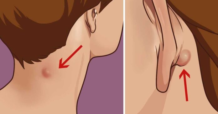 Kodėl atsiranda iškilimų už ausies ar ant kaklo ir kaip juos pašalinti?