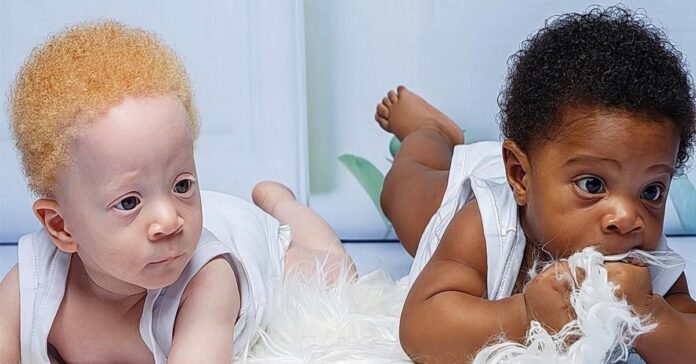 Viena moteris pagimdė dvynius - juodaodį ir baltaodį. Kaip reagavo jų tėvas?