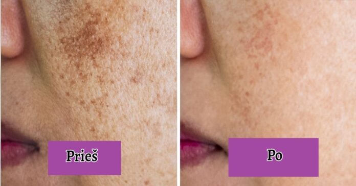 Patarimai, kaip sveikai sumažinti ant odos atsiradusias tamsias dėmes