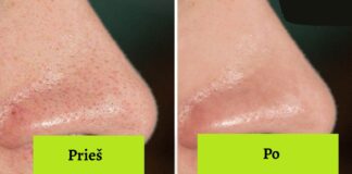 Dermatologai rekomenduoja: 10 patarimų, kaip sutraukti odos poras