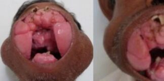 Gydytojai pašalino milžinišką ataugą iš vyro burnos. Dabar jis atrodo visiškai kitaip!