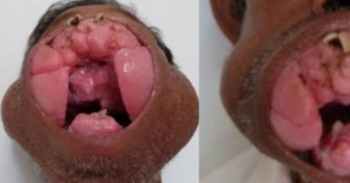 Gydytojai pašalino milžinišką ataugą iš vyro burnos. Dabar jis atrodo visiškai kitaip!
