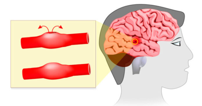 Pirmieji galimos smegenų aneurizmos požymiai. Svarbu juos žinoti