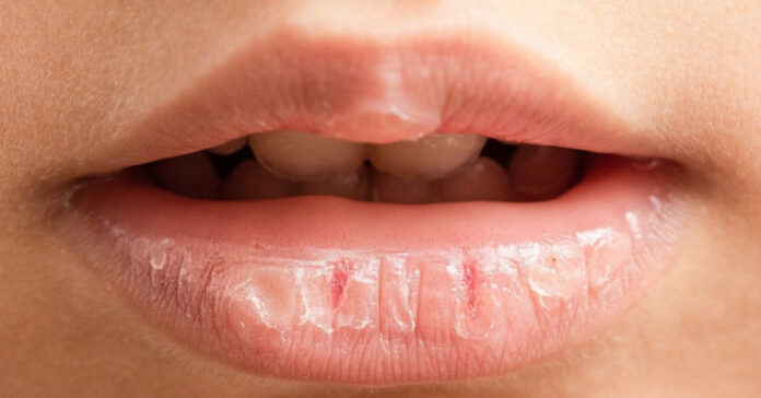 Kokios rizikos kyla, jei naudojate per daug lūpų balzamo?
