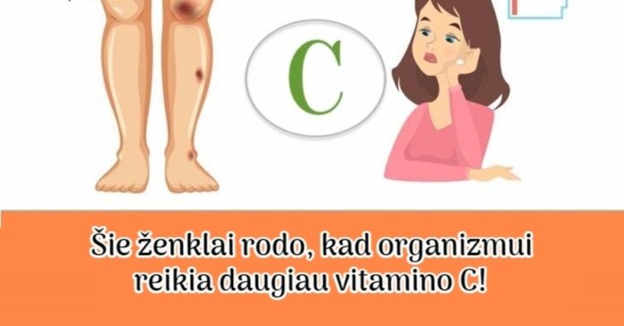7 ženklai, kad jūsų organizmui reikia daugiau vitamino C!