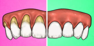 4 ženklai, kad per stipriai valote dantis, ir 4 būdai, kaip ištaisyti šį blogą įprotį