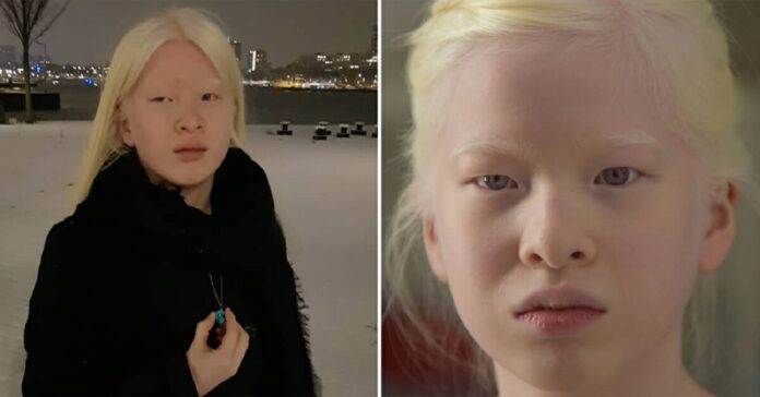 Tėvai atsisakė auginti savo dukrą dėl jos albinizmo. Galiausiai ji tapo fotomodeliu
