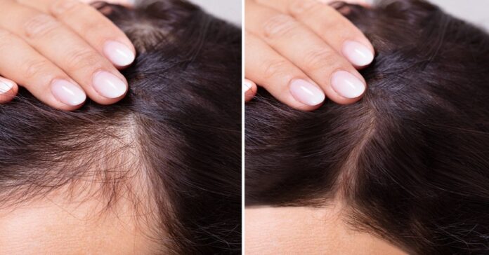 Kaip pažadinti neveikiančius plaukų folikulus?