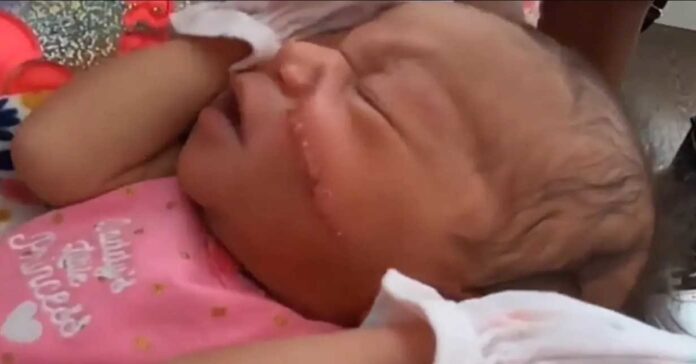 Kūdikis gimė su didele žaizda ant veido. Tai buvo gydytojo klaida...